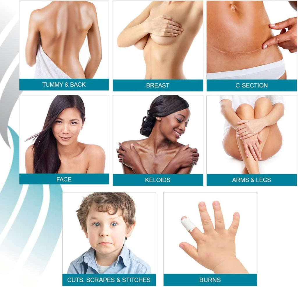 NewGel+ Silicone Gel Sheeting for Scar Management - 5 inch x 6 inch Sheet Clear (1 per box)