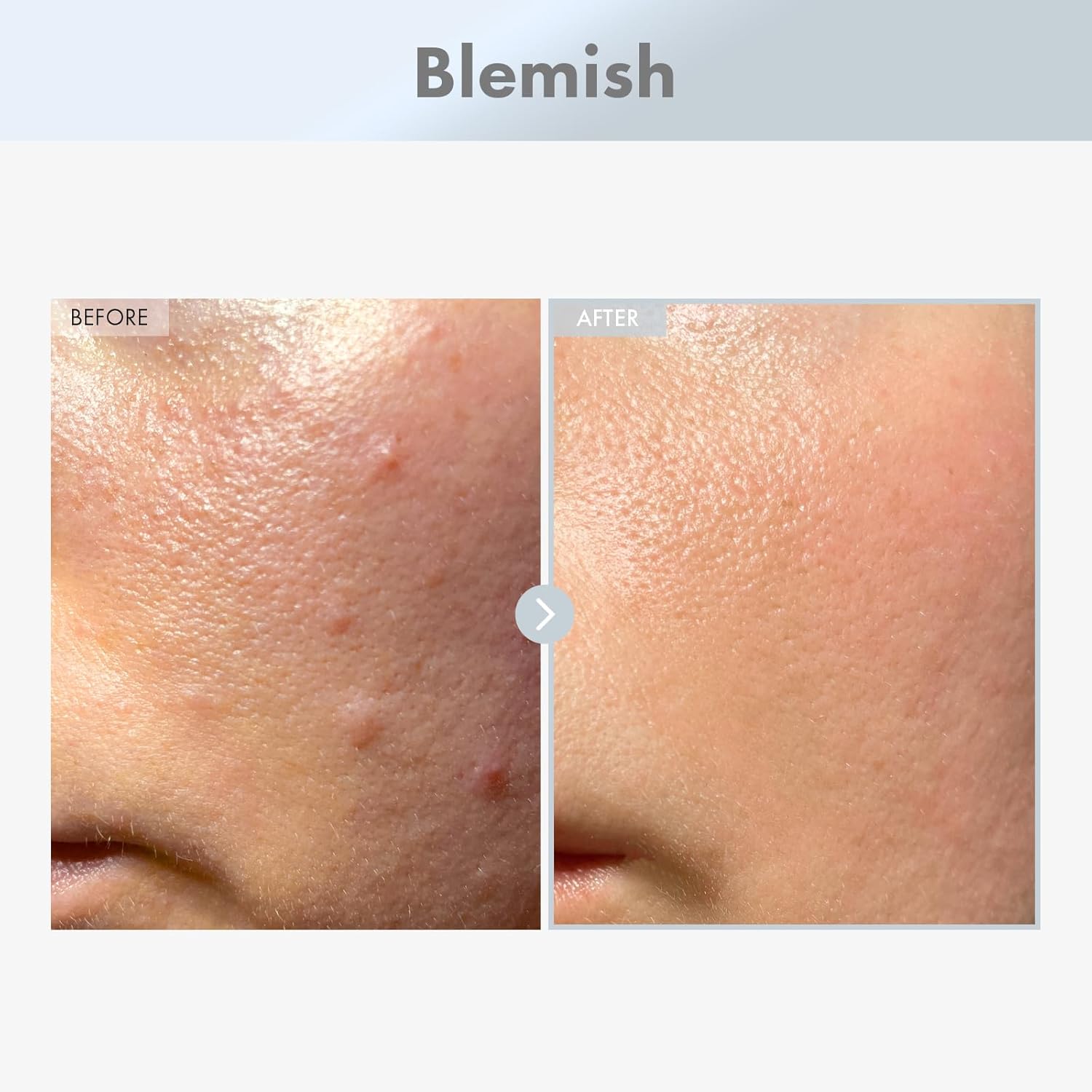 TOSOWOONG Niacinamide 15% Face Serum, 150,100ppm Niacinamide, Tranexamic acid, Supports Even Skin Tone, Glass Skin, Radiant Complexion, Refines Appearance of Pores, Korean Skin Care, 30ml, 1.01 fl.oz