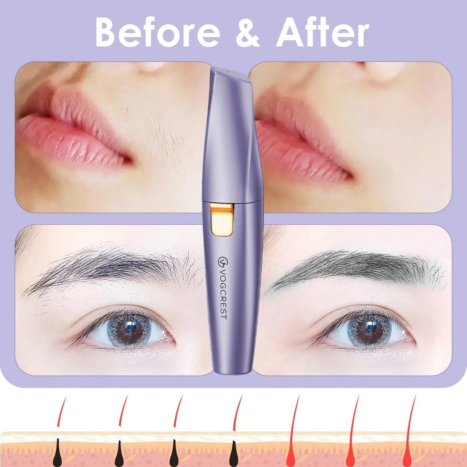 Before and after results of fine hair removal on eyebrows and upper lip with device diagram