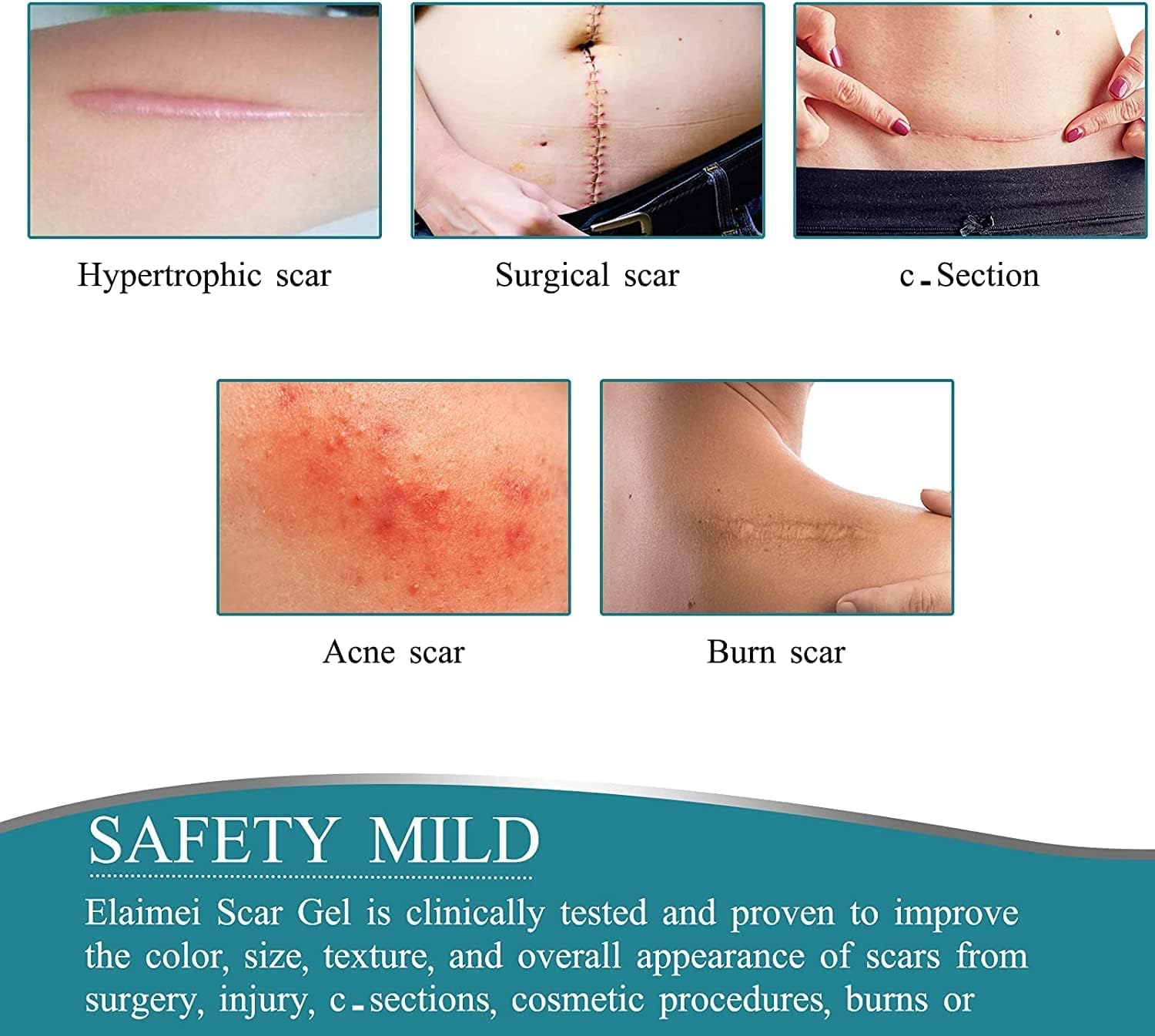 Wifamy Silicone Scar Sheets(1.6'' x 60''Roll-1.5M) - Soft Silicone Gel Scar Tape Painless Silicone Tape Roll - Effective Silicone Scar Removal Strips Sheets for C-Section & Keloid Surgery, Burn, Acne