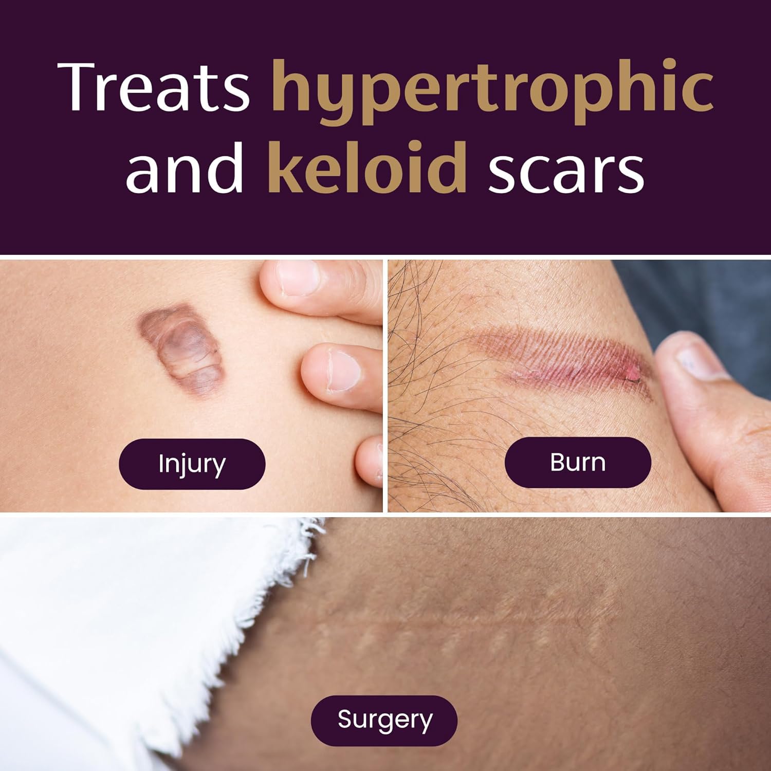 Mederma Medical Grade Silicone Scar Sheets; Improves The Appearance of Old and New Scars; for Injury, Burn and Surgery Scars, 4 Count