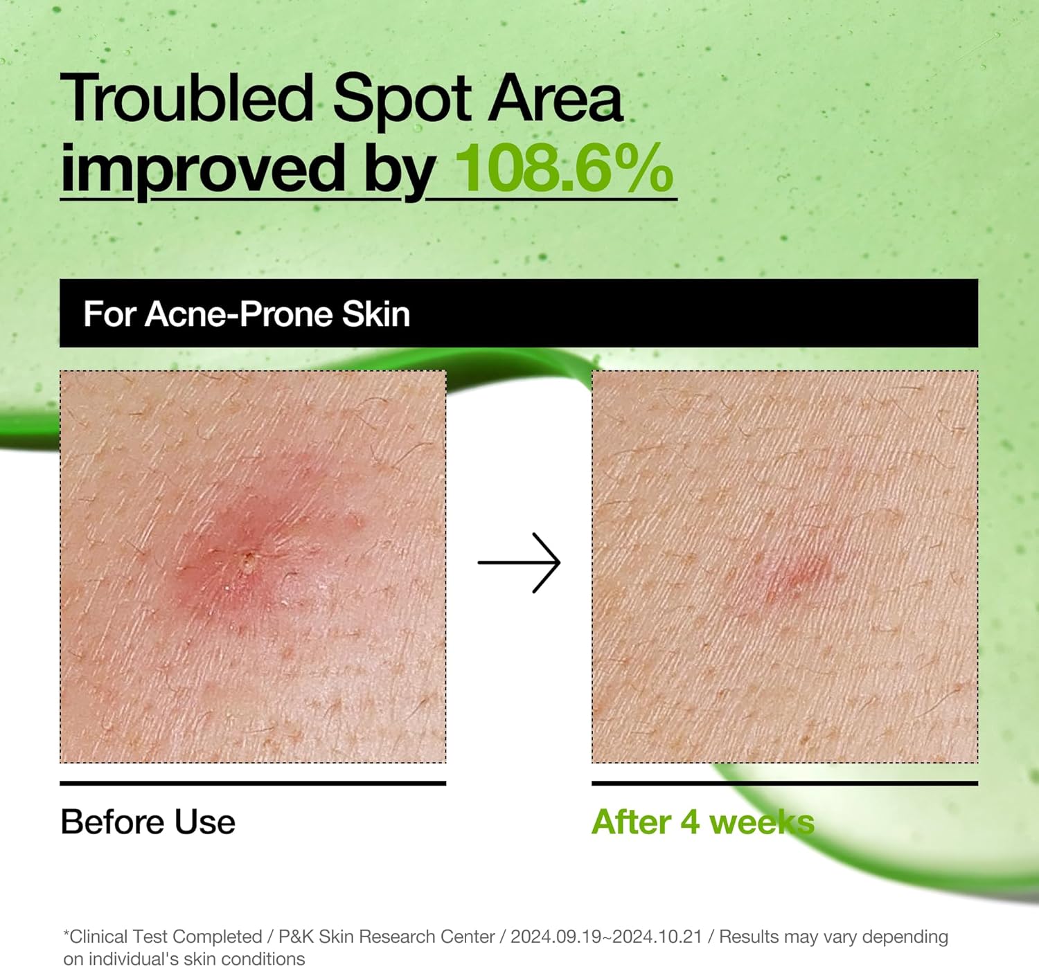 Anua Azelaic Acid 10 Hyaluron Redness Soothing Serum, Facial Serum for Sensitive skin, Hyaluronic Acid, Niacinamide, Spot Care, Natural Color, Vegan, Korean Skincare (30ml/ 1.01 fl oz.)