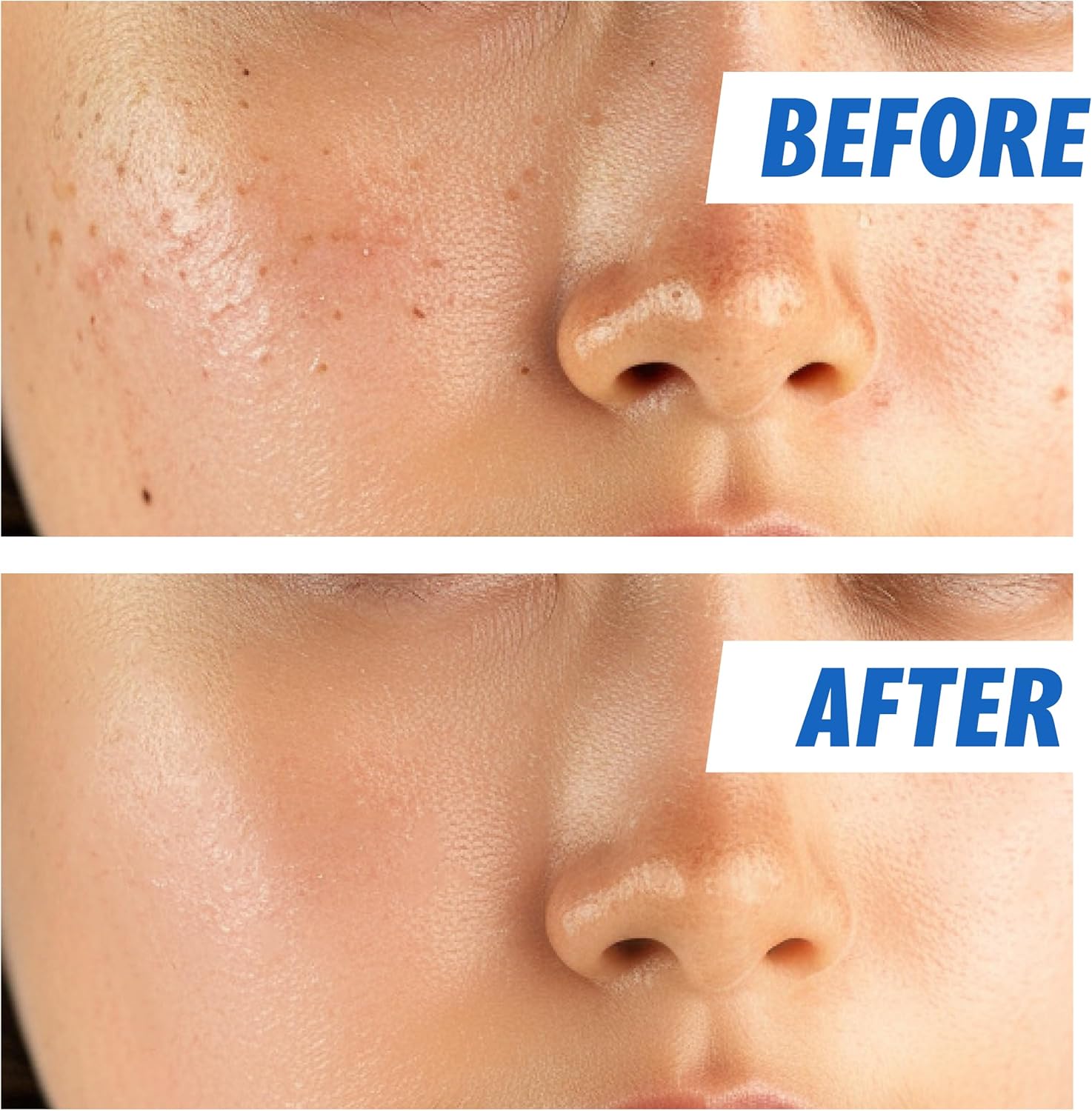 Nightingale ECTO Hyaluronic Hydrating Toner 200ml - Korean Skin Care Moisturizing & Brightening Treatment with Alantoin & CECA - Hypoallergenic, Cruelty Free, Natural Ingredients for Sensitive Skin