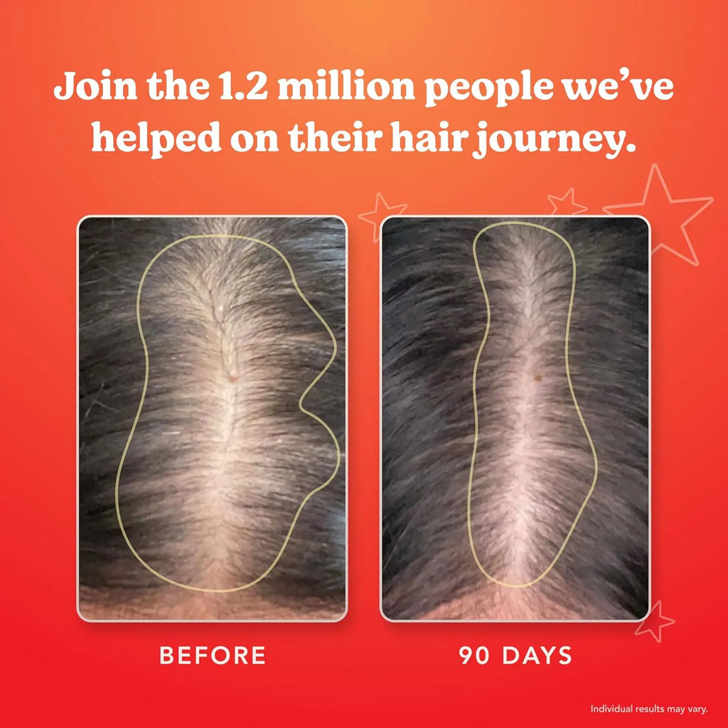 HAIRtamin before and after hair growth results showing denser coverage in 90 days