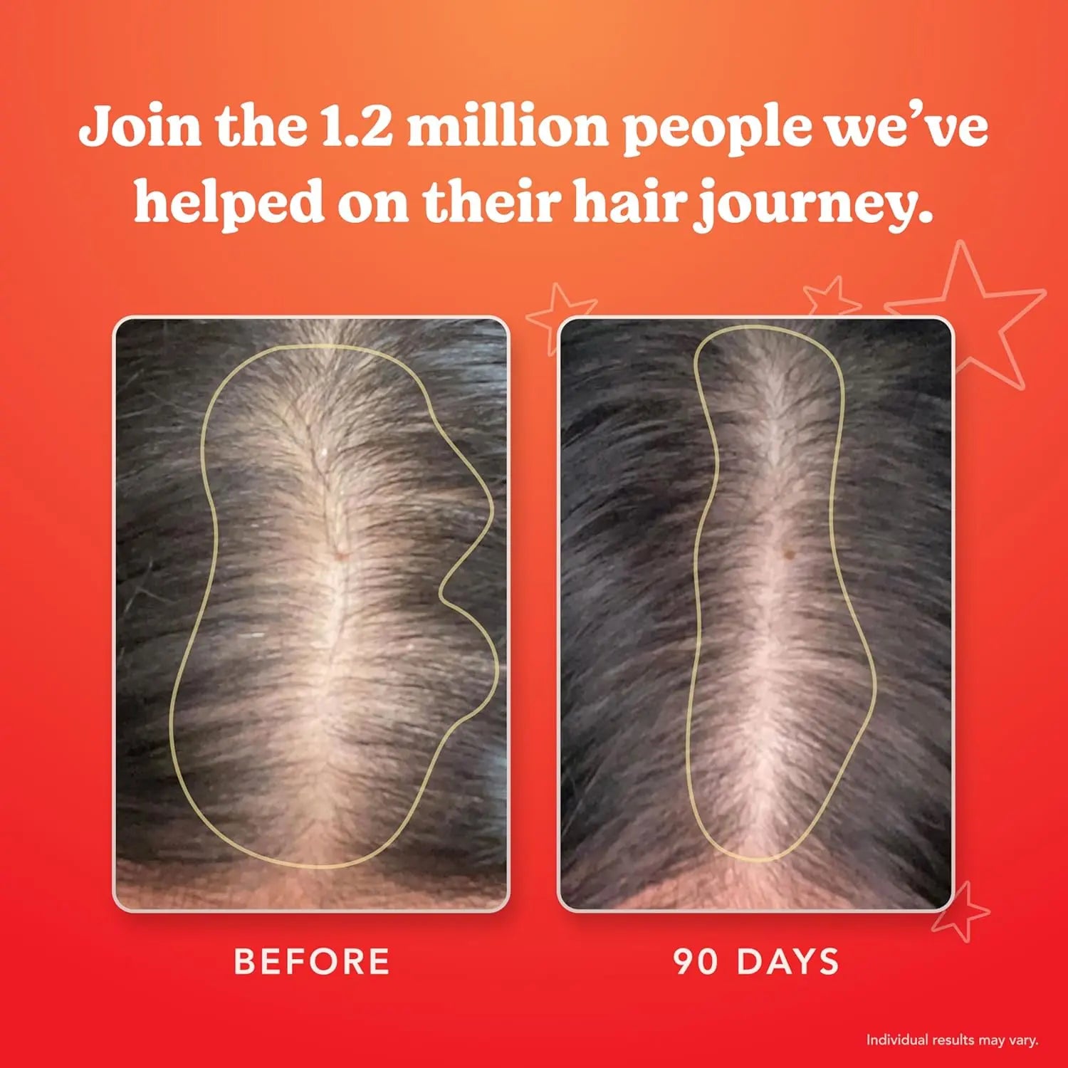 HAIRtamin before and after hair growth results showing denser coverage in 90 days