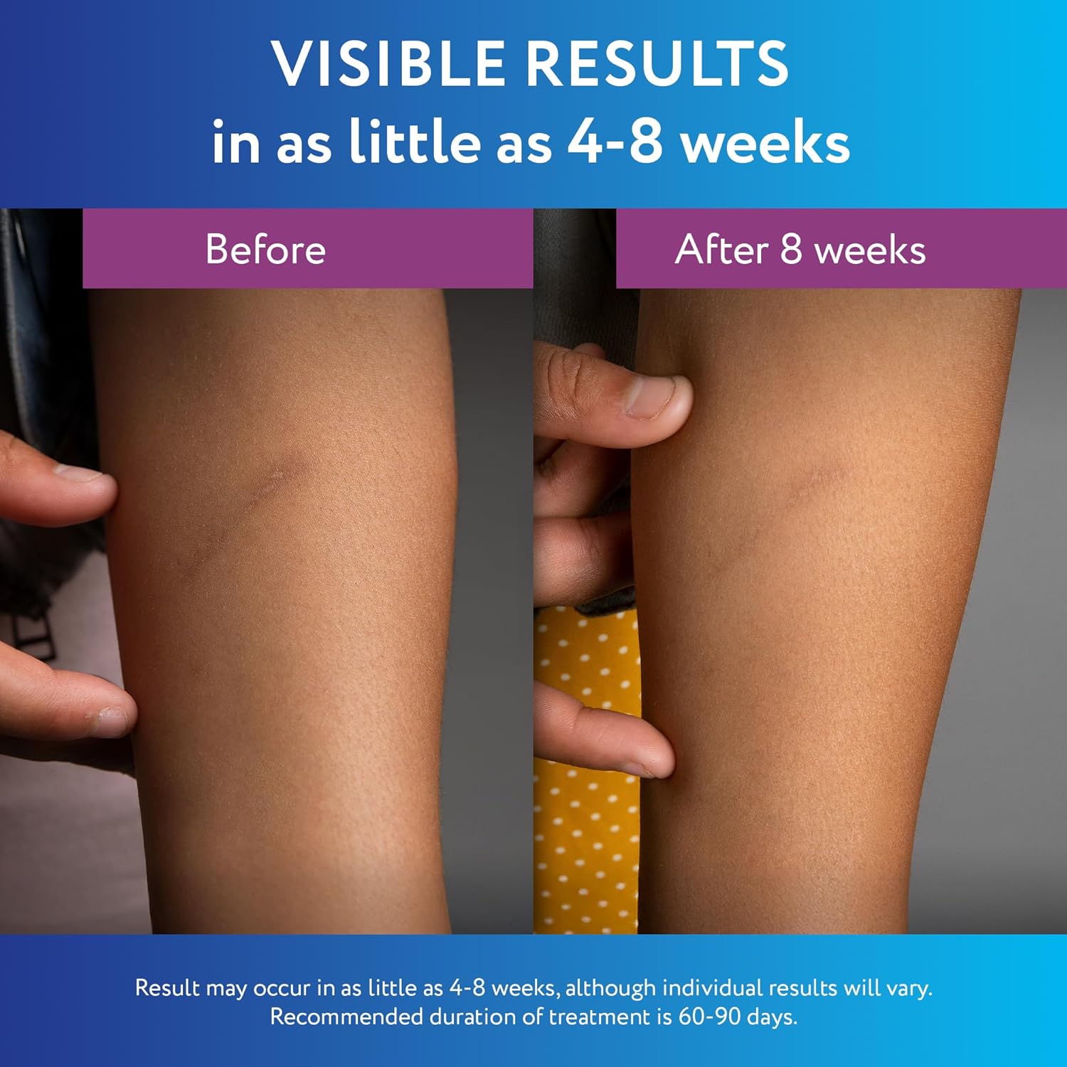 ScarAway Silicone Gel 10g